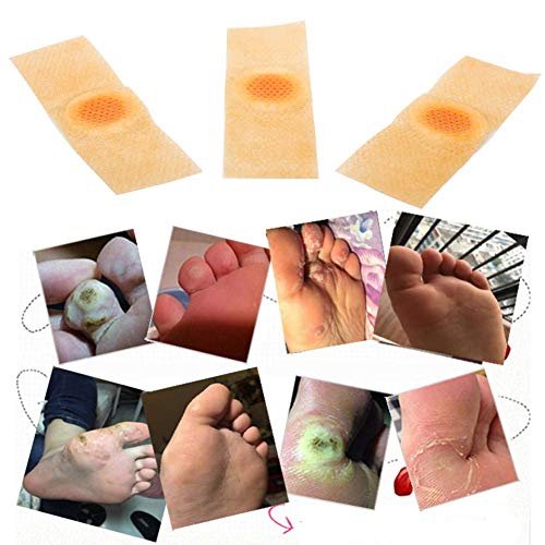 Wart Remover, Verrugas, Tratamiento Anti Verrugas Tratamiento para Quitar Verrugas Comunes y Plantares, Congela las Verrugas de Raíz, Wart Remover para Pies y Manos