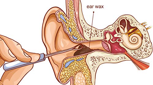 Remos Asa auricular, longitud 7 cm acero inoxidable